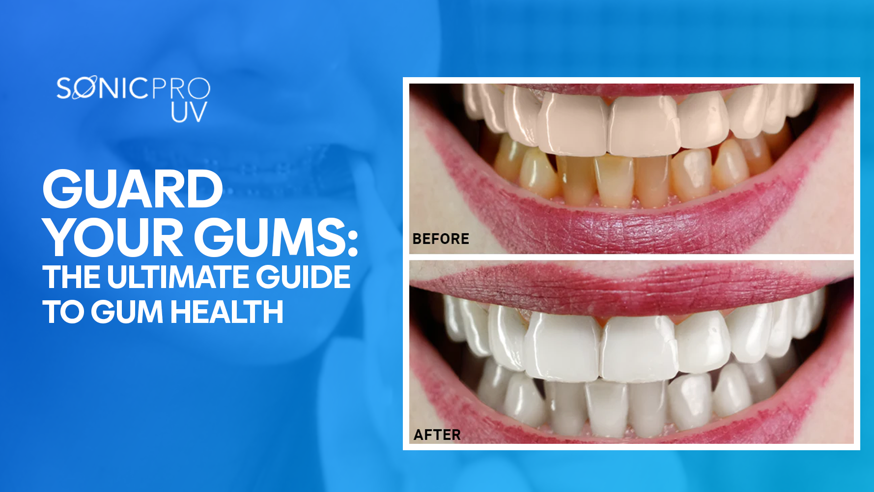 Before and after smile showing SonicPro UV oral care benefits.